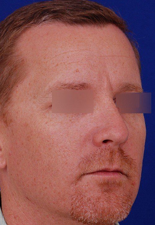 male rhinoplasty after