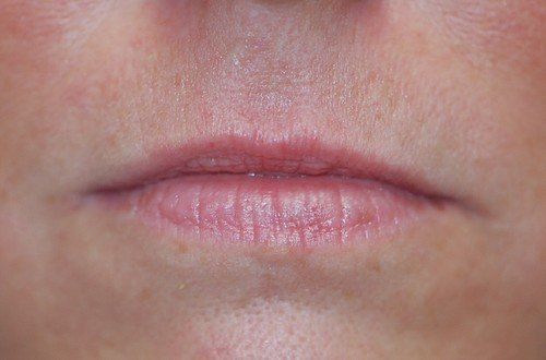 Female Before Lip Filler