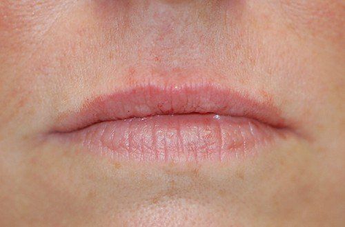 Female After Lip Filler