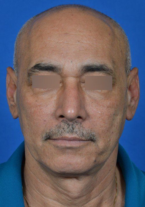 male rhinoplasty after