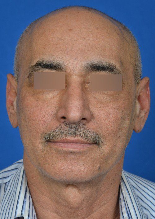 male rhinoplasty before