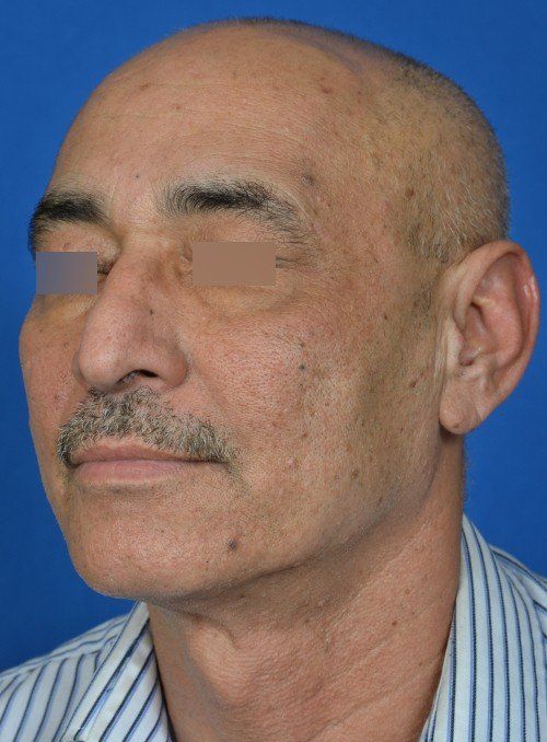 male rhinoplasty before