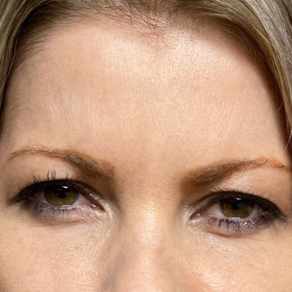 after dysport picture with wrinkles between eyebrows gone