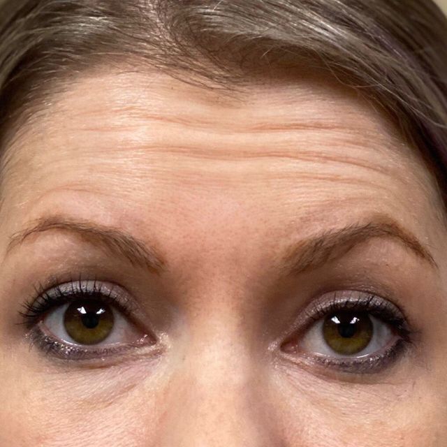 tirzepatide wearing off Is Your Botox or Dysport Wearing Off Too Quickly?