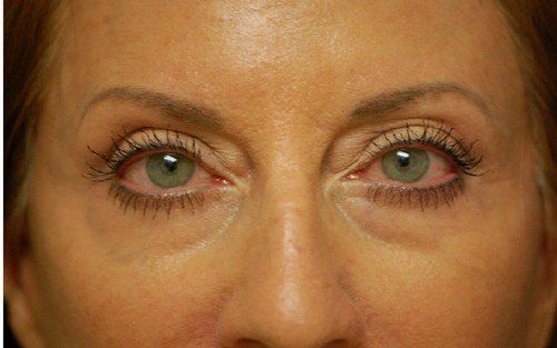 after chemical peel around eyes