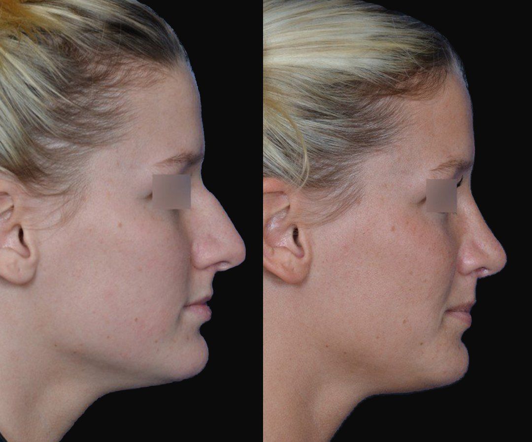 dorsal hump rhinoplasty before and after