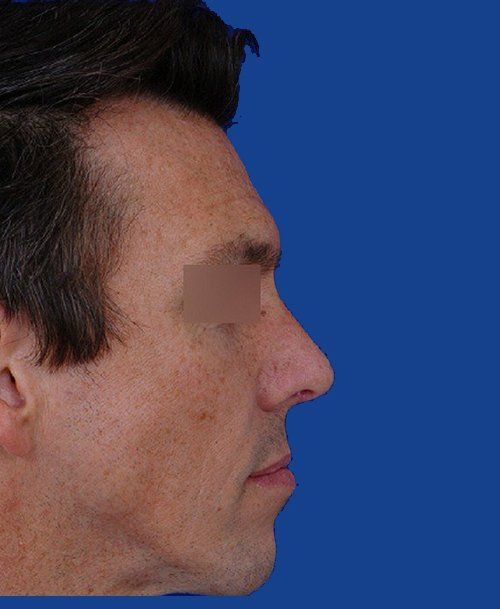 Male Rhinoplasty After Picture