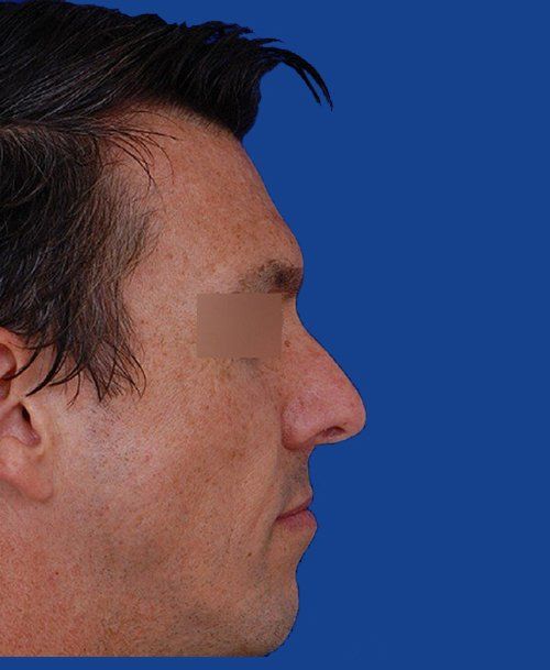 Male Rhinoplasty Before Picture