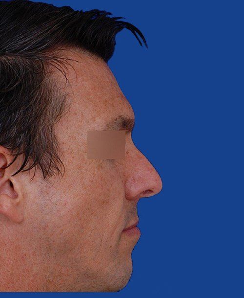 Ethnic Nose Surgery Before and After Photo Gallery - Nose Surgery Photos