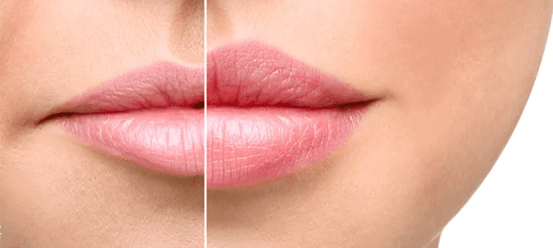 lip enhancement procedures