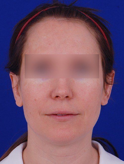 female after otoplasty