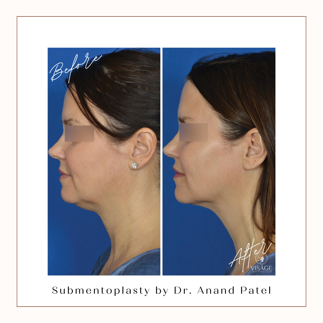 submentoplasty by dr anand patel before and after photos
