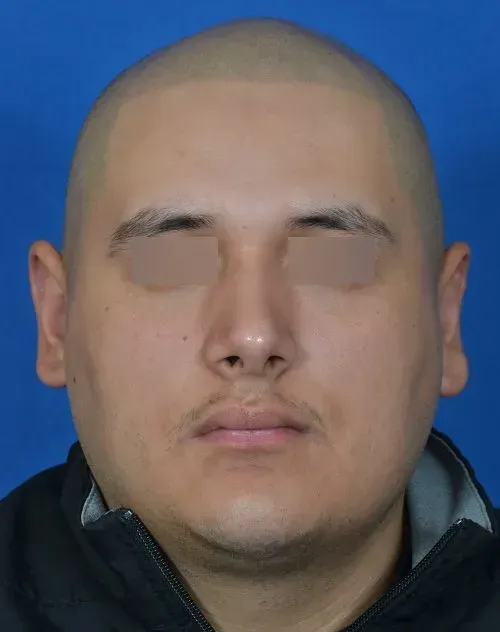 male after otoplasty