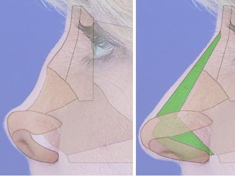 revision rhinoplasty visage facial plastic surgery
