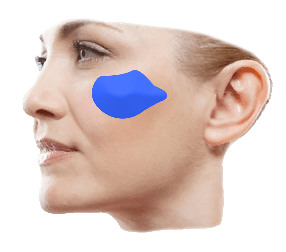 facial implant