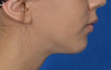 after chin implant female