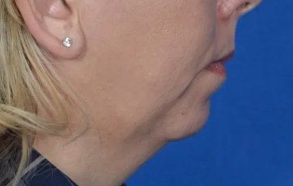 chin implant before