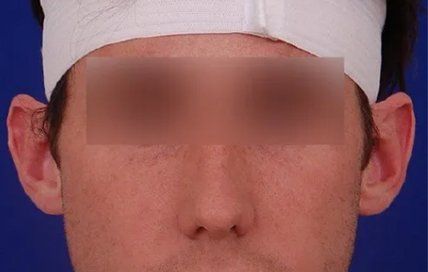 Ear & Earlobe Surgery  Visage Facial Plastic Surgery