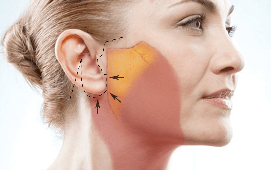 facelift incision