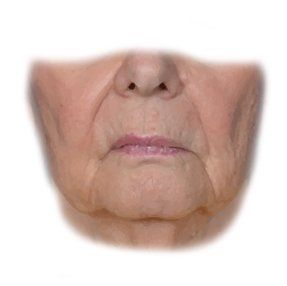 hollow cheeks