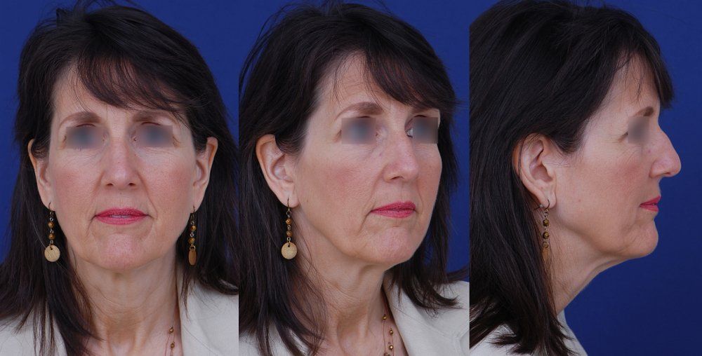 female patient before facial plastic surgery