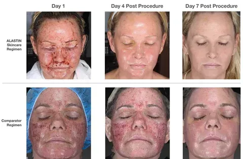comparison of alastin skincare results before and after skin resurfacing