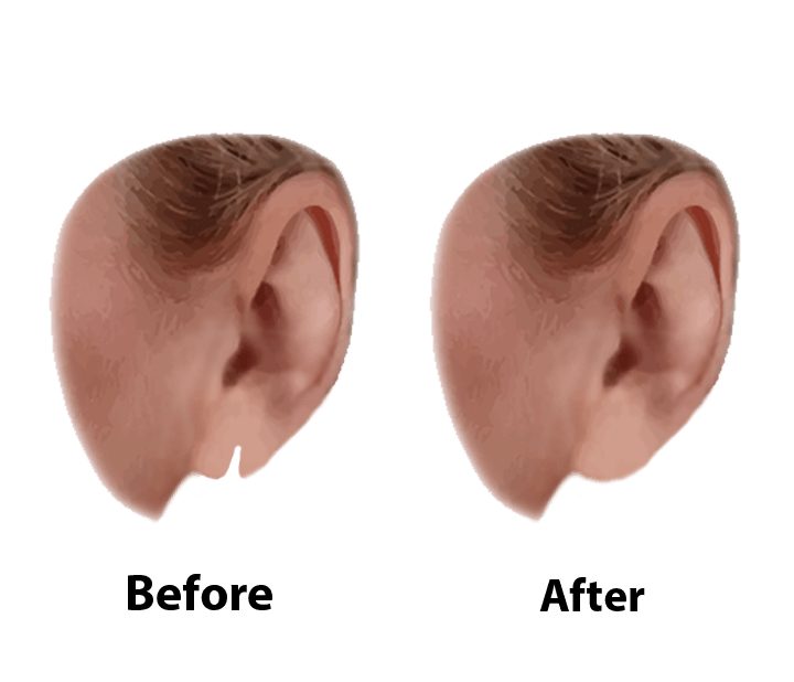 Earlobe Repair Big Ear Surgery Cost Split Earlobe Repair Small