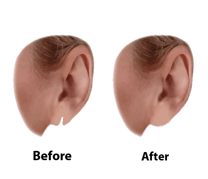 Stretched or Split Ear Lobe Repair in SG