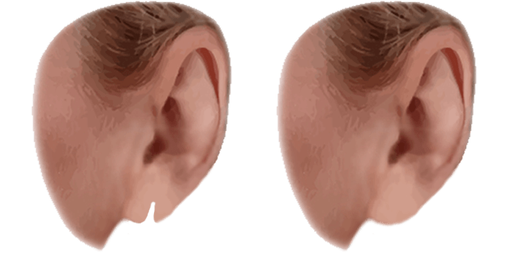split earlobe repair surgery