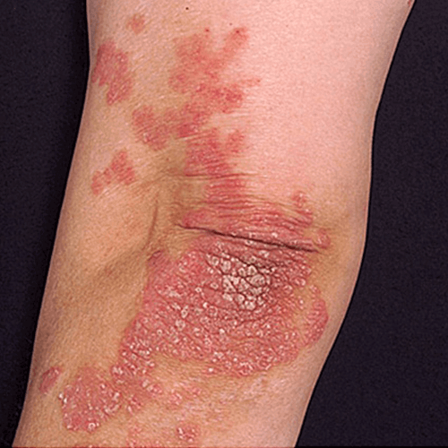 Artritis psoriasica