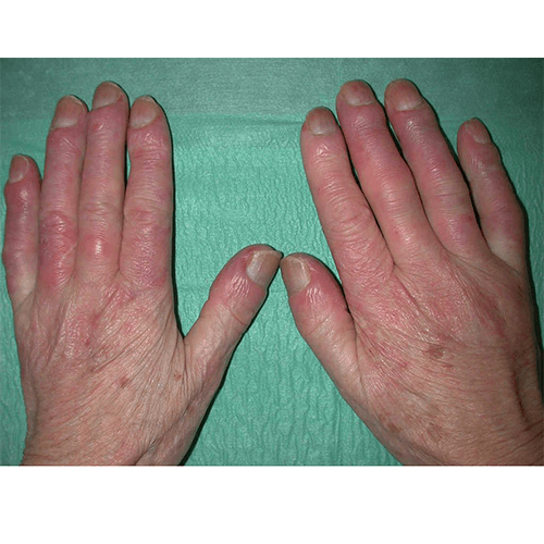 Esclerosis sistemica