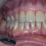 side view of full set of teeth