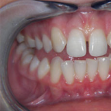 teeth, gums and mouth guard