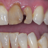 yellowish teeth