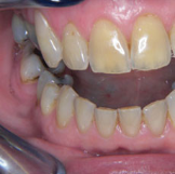 Discoloured teeth