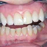 top and bottom teeth