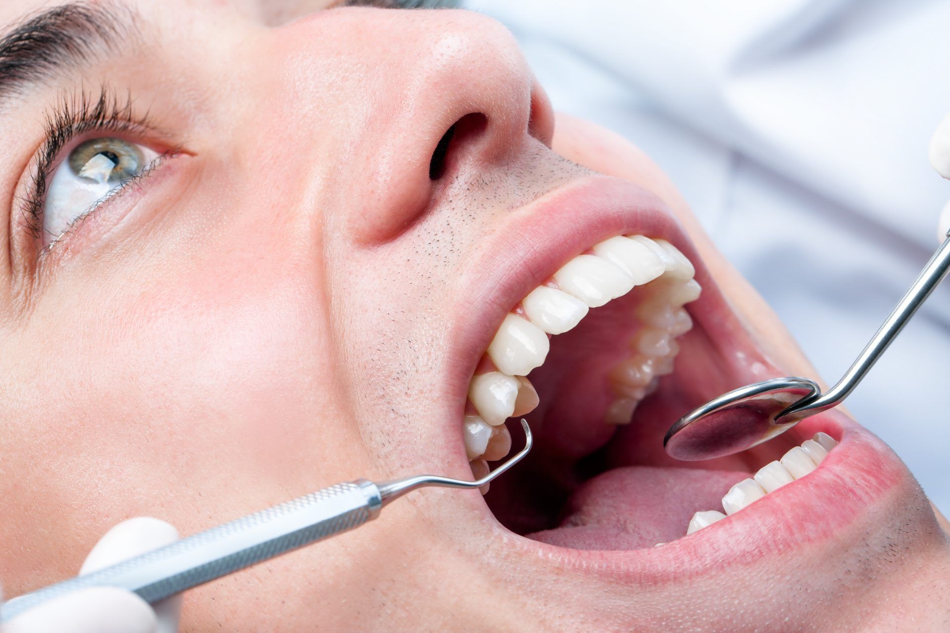 sbiancamento dentale