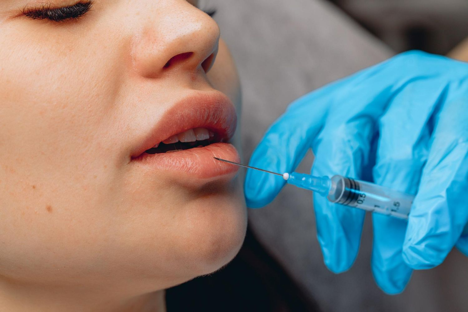 Person receiving lip filler injections. A gloved hand holds a syringe near their lower lip.