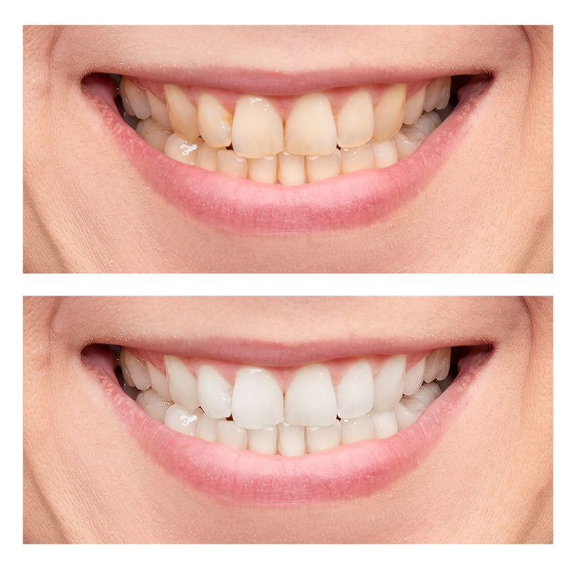 A Before and After Picture of A Woman's Teeth — Brow & Lash Clinic In Cairns