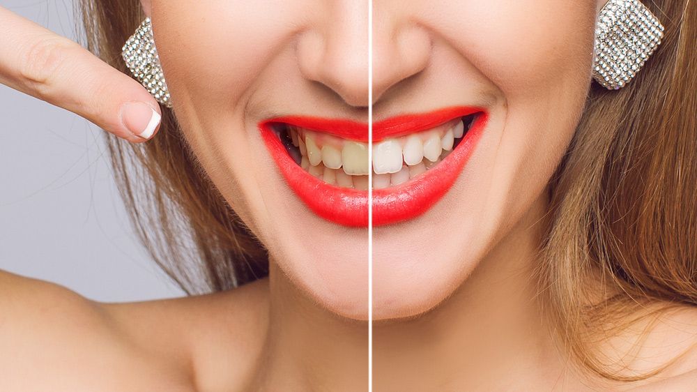 A Woman with Red Lipstick Is Pointing at Her Teeth Before and After Whitening — Brow & Lash Clinic In Cairns