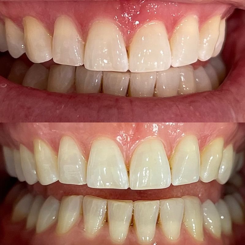 A Before and After Picture of A Person's Teeth — Brow & Lash Clinic In Cairns
