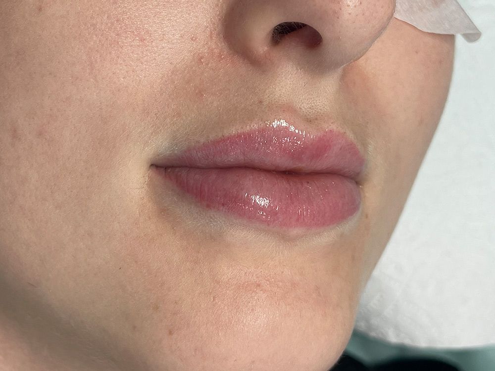 Close up Of a Woman's Lips with a Bandage on Her Nose — Brow & Lash Clinic In Cairns