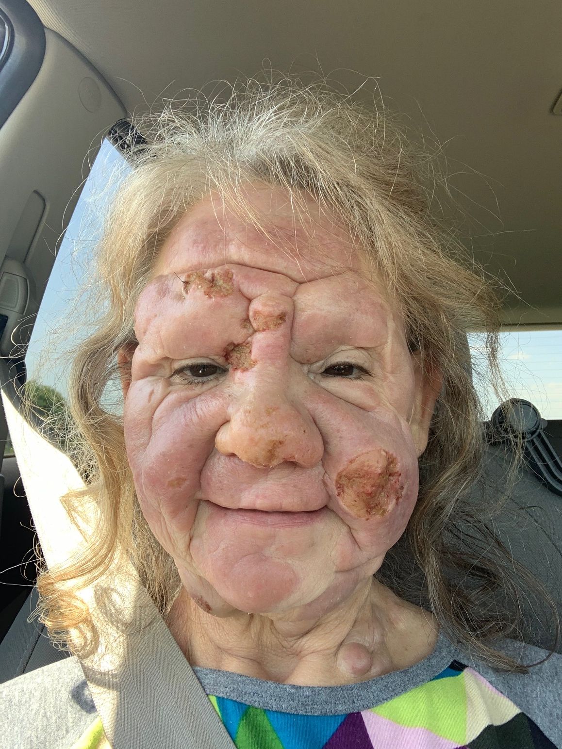 lady with open sores on face