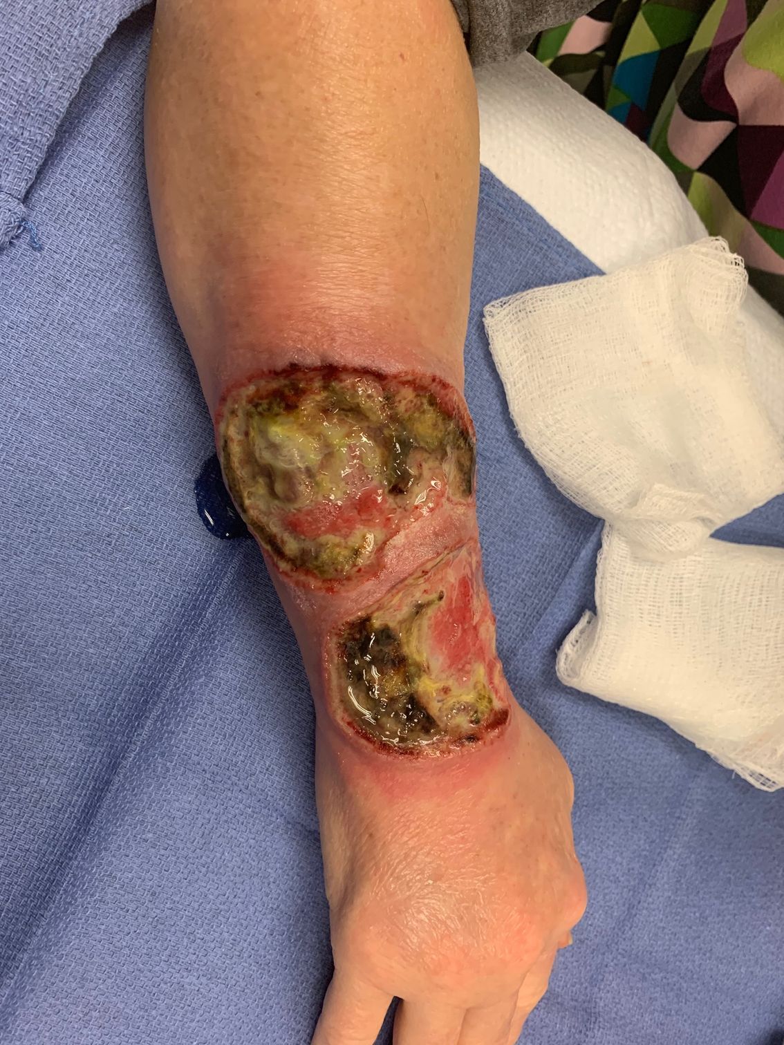 arm with open sores