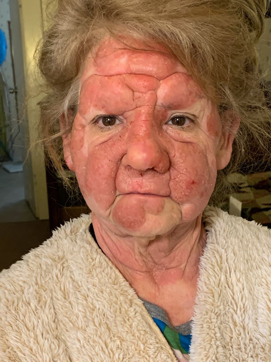 lady with red swollen face