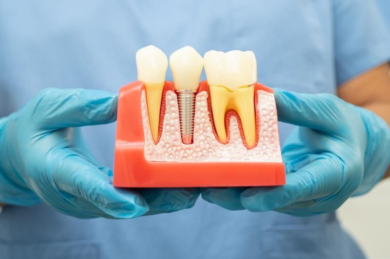 various types of permanent denture implants.