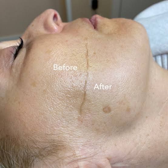 Comparación en vista dividida que muestra el resultado de un tratamiento cutáneo 