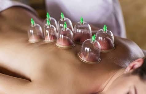 Una persona tumbada boca abajo durante una sesión de terapia con ventosas en la espalda