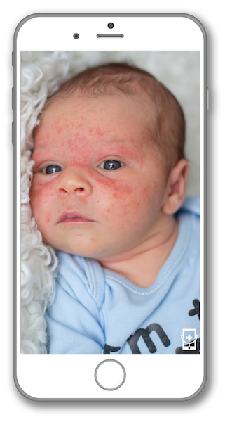 A baby with red spots on his face is on a cell phone