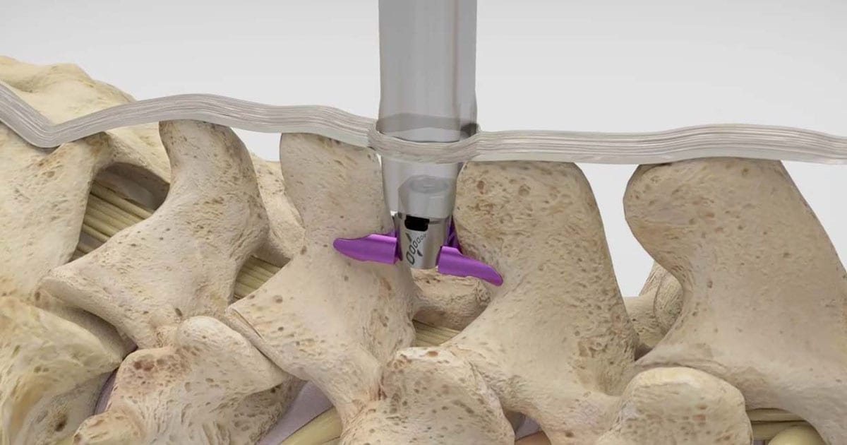 Vertiflex® Spinal Stenosis Treatment in the Antelope Valley, California